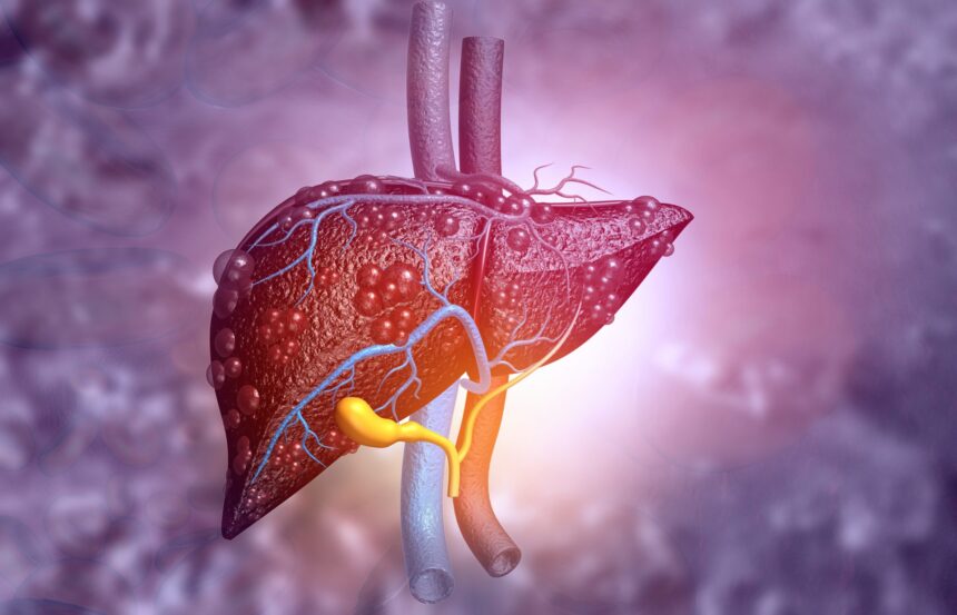 Fatty Liver Disease, A Diabetes Complication, Deserves More Attention