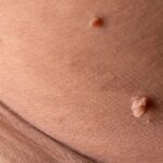 Diabetes and Skin Tags