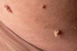 Diabetes and Skin Tags