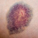 Does Diabetes Make You Bruise Easily?